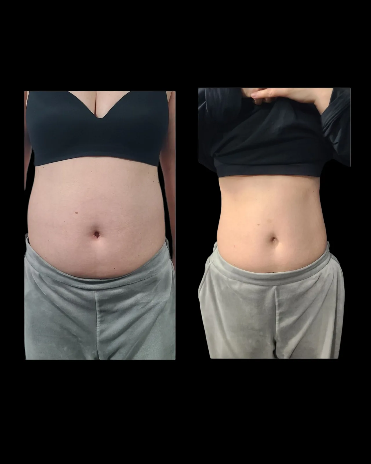 Emsculpt NEO Results 9